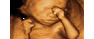 3-D image of a fetus at 18 weeks gestation
