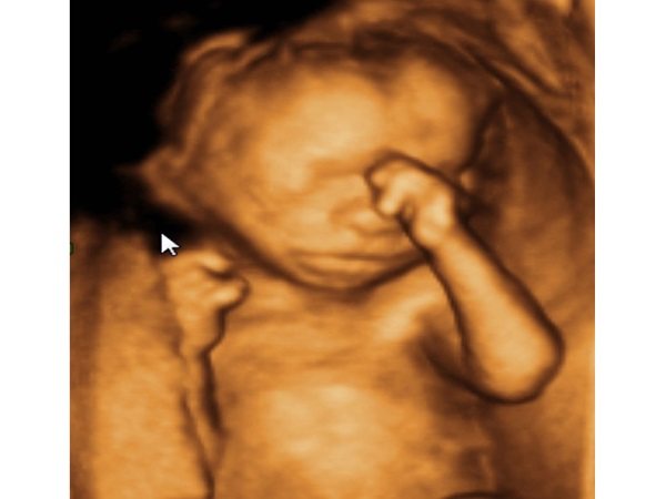 3-Д изображение плода на сроке беременности 18 недель