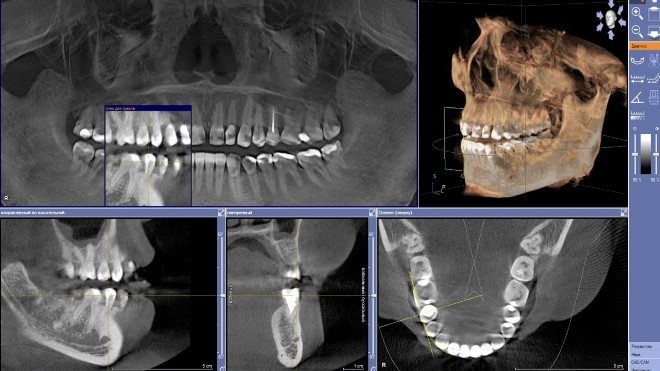 3Д снимок зубов