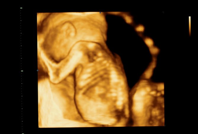4 D ultrasound