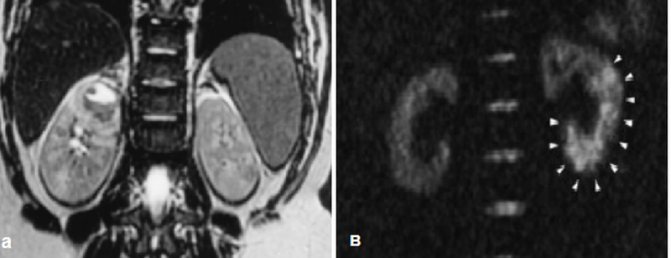 Abscess and ischemic zone during renal infarction