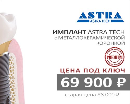 Promotion: Astra Tech implant with metal-ceramic crown