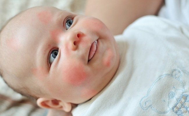 Allergies in babies