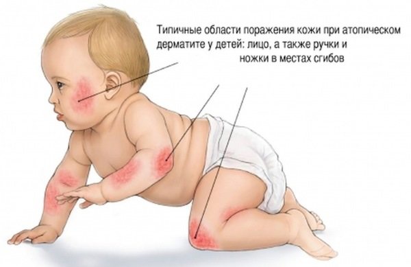 Аллергия у новорожденного пищевая при грудном вскармливании. Как выглядит на лице, ушах, теле. Лечение: капли, крема, мази