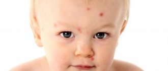 Аллергия у ребенка на грудном вскармливании
