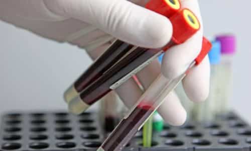 A blood test shows the concentration of triiodothyronine (T3) in the patient&#39;s blood (pmol/l)