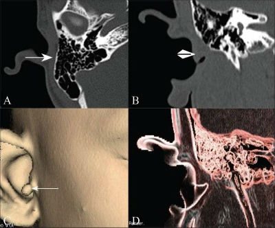 Angiography of the inner ear with MRI