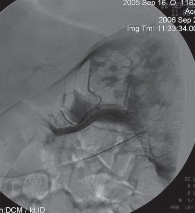 Angiogram of the spleen after its repeated occlusion in a patient with hemolytic anemia