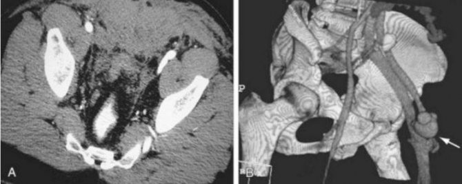 Arteriovenous fistula between the femoral artery and femoral vein on CT angiography of the arteries of the lower extremities (indicated by an arrow)