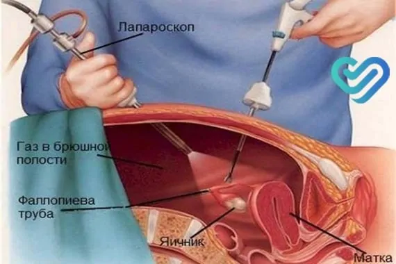 What is laparoscopy?