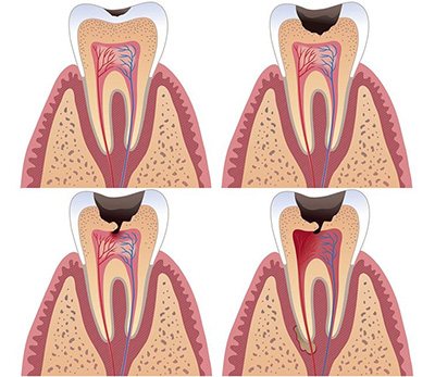 What is tooth pulpitis