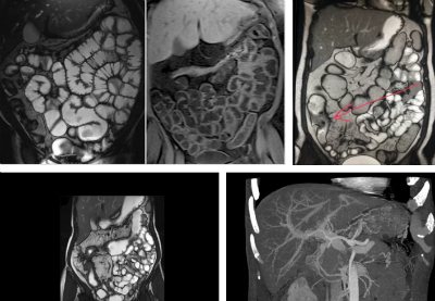 what can be seen on an MRI of the stomach and intestines