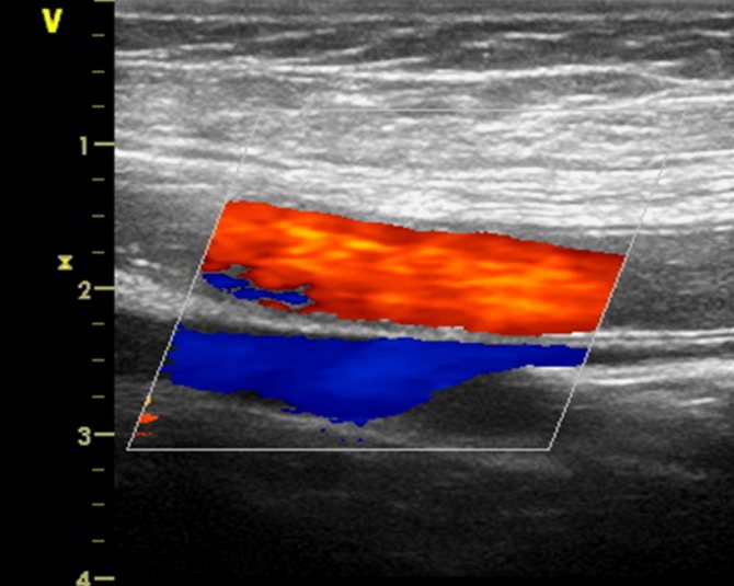 Color Doppler mapping