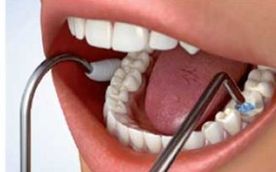 Depophoresis - Dentistry Line of Smiles