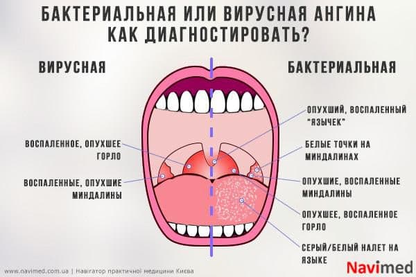diagnosis of sore throat