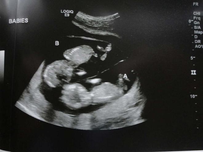 Twins in ultrasound picture