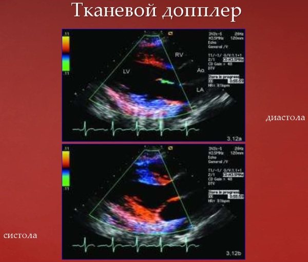 ECHO (echocardiography) of the heart. What shows normal indicators, how they do it 