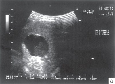 Sonographic picture of a primary splenic cyst