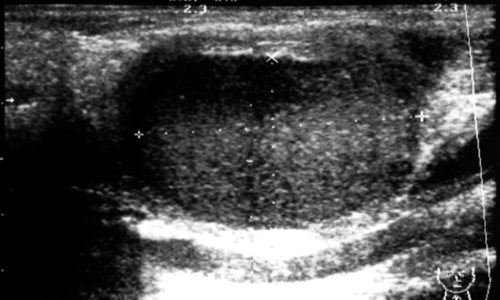 Echogram - branchial (lateral) cyst of the neck, relationship with the vascular bundle of the neck (compression of the internal jugular vein and displacement of the common carotid artery)