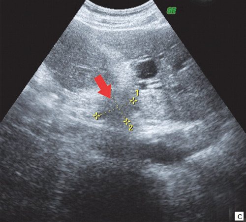 Echogram - hypoechoic formation 28 x 26 mm with uneven, fuzzy contours at the porta hepatis (arrow)