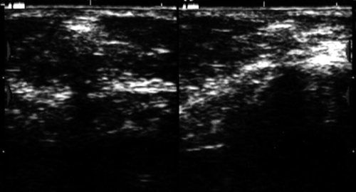 Echogram - foreign body in the subcutaneous tissue of the left cheek (glass fragment)