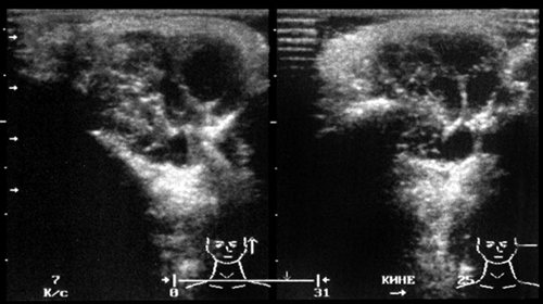 Echogram - lymphangioma of the left parotid gland