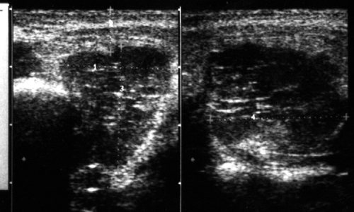 Echogram - lipoma of the left parotid gland