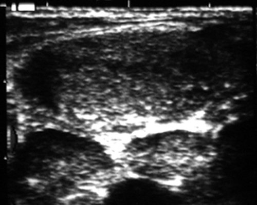 Echogram - acute reactive (inflammatory) hyperplasia of the cervical lymph node