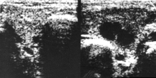 Echogram - acute serous lymphadenitis with widespread periadenitis (lymphogenous parotitis, Herzenberg&#39;s parotitis) in the left parotid gland