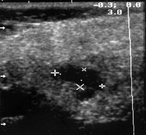 Echogram - acute serous lymphadenitis in the left parotid gland with limited periadenitis
