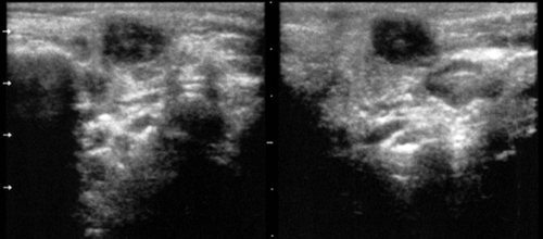 Echogram - acute serous lymphadenitis in the left parotid gland (in two scanning planes)