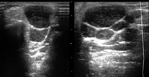 Echogram - damage to the left parotid gland with a lymphoproliferative disease (lymphogranulomatosis)