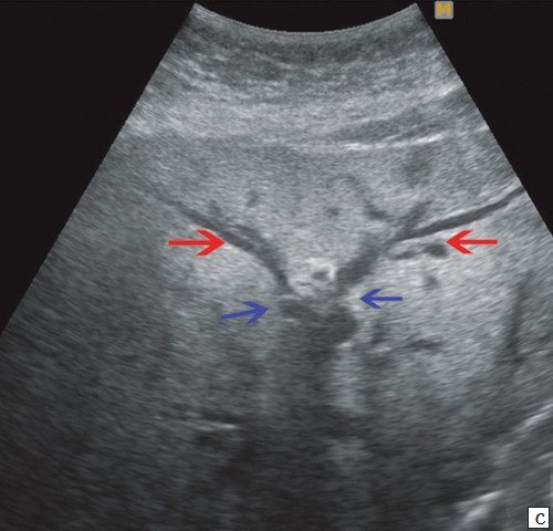 Echogram - interruption of visualization of the ducts in the area of ​​confluence of the lobar ducts of the liver (blue arrows), lobar ducts (red arrows)