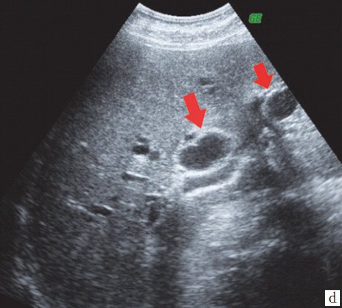 Echogram - expansion of the right lobar and left segmental ducts (arrows)