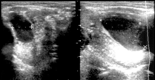 Echogram - retention cyst of the right sublingual gland