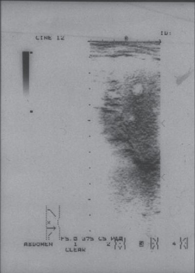 Echogram of the spleen in Hodgkin&#39;s lymphoma