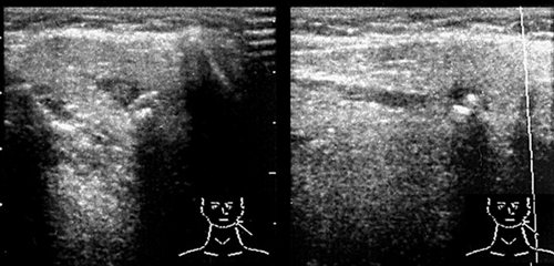 Echogram - salivary stone disease, calcified stones in the parenchyma of the left submandibular gland, perifocal edema of the gland parenchyma