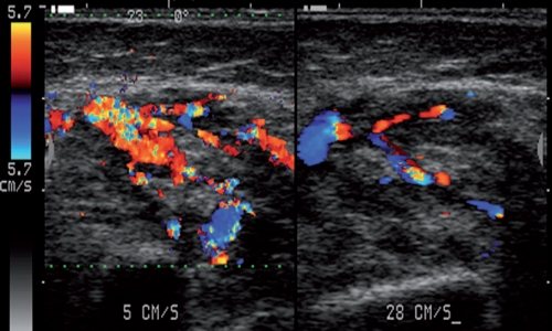 Echogram - vascular hyperplasia of the right buccal region