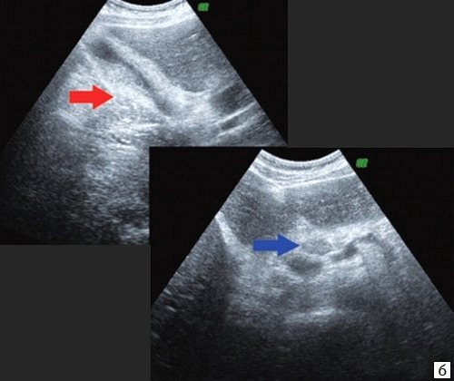 Echogram - collapsed gallbladder (red arrow), paraportal lymph node (blue arrow)