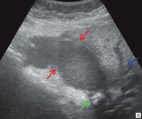 Echogram - enlarged gallbladder filled with thick bile (red arrows), fixed stone in the neck of the gallbladder (green arrow), dilated intrahepatic ducts (blue arrow)