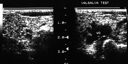Echogram - venous dysplasia of the right parotid gland