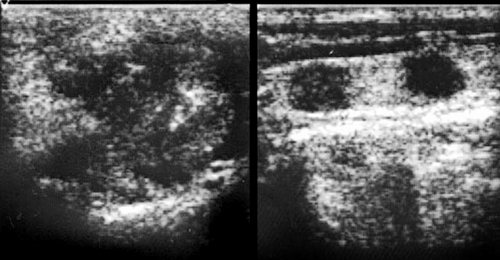 Echogram - malignant tumor of the left parotid gland (adenocystic carcinoma), metastatic lesion of regional lymph nodes