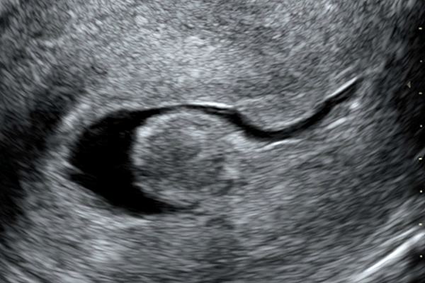 Endometritis after childbirth on ultrasound