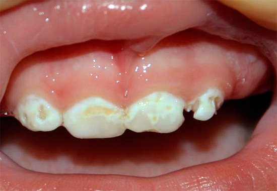 Еще один пример бутылочного кариеса у ребенка: если вовремя не начать лечение зубов, то за короткий промежуток времени они могут быть разрушены практически полностью.