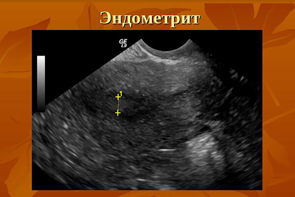 Photo: Endometritis on ultrasound