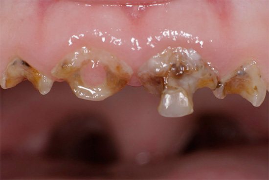 Generalized caries of primary teeth in a child.