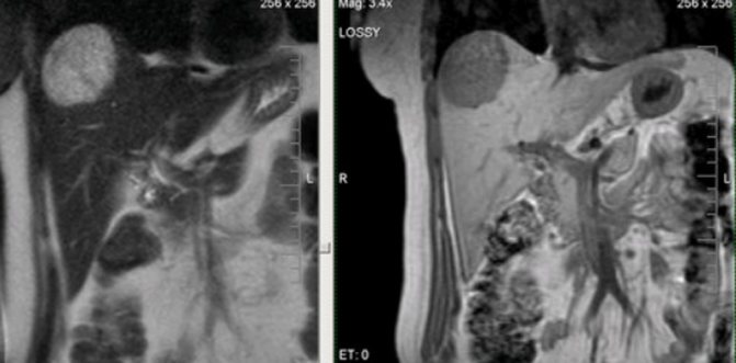 Hepatocellular carcinoma on an MRI image