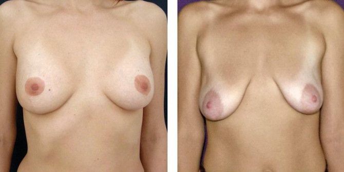 грудь до и после родов у девушки