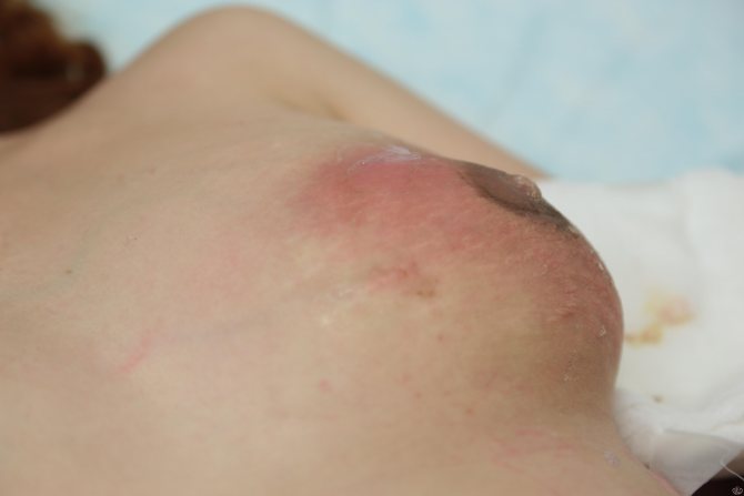 breast with purulent mastitis