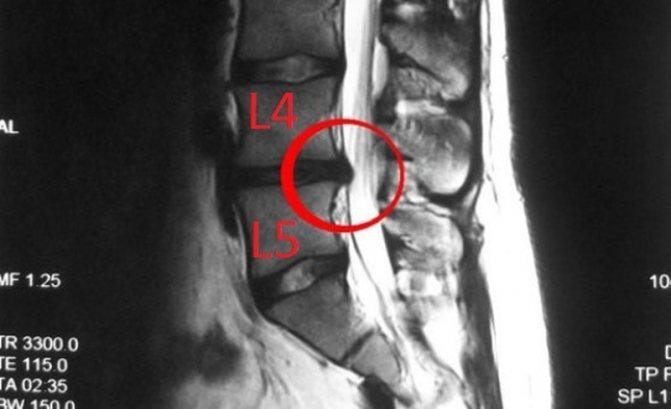 Endplate herniation on MRI